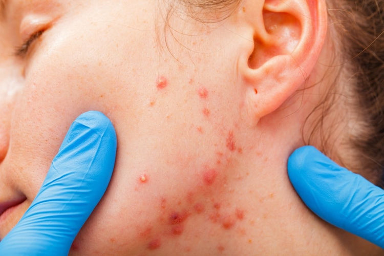 Understanding Acne: Your Guide to Clearer Skin