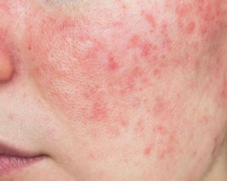 How to Treat Rosacea