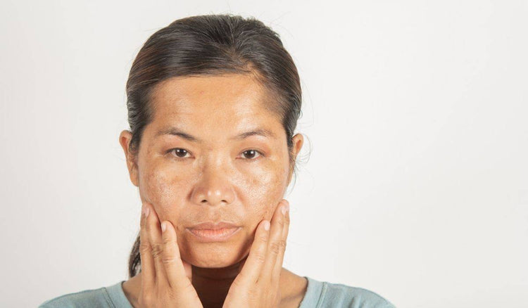 How to treat Melasma!