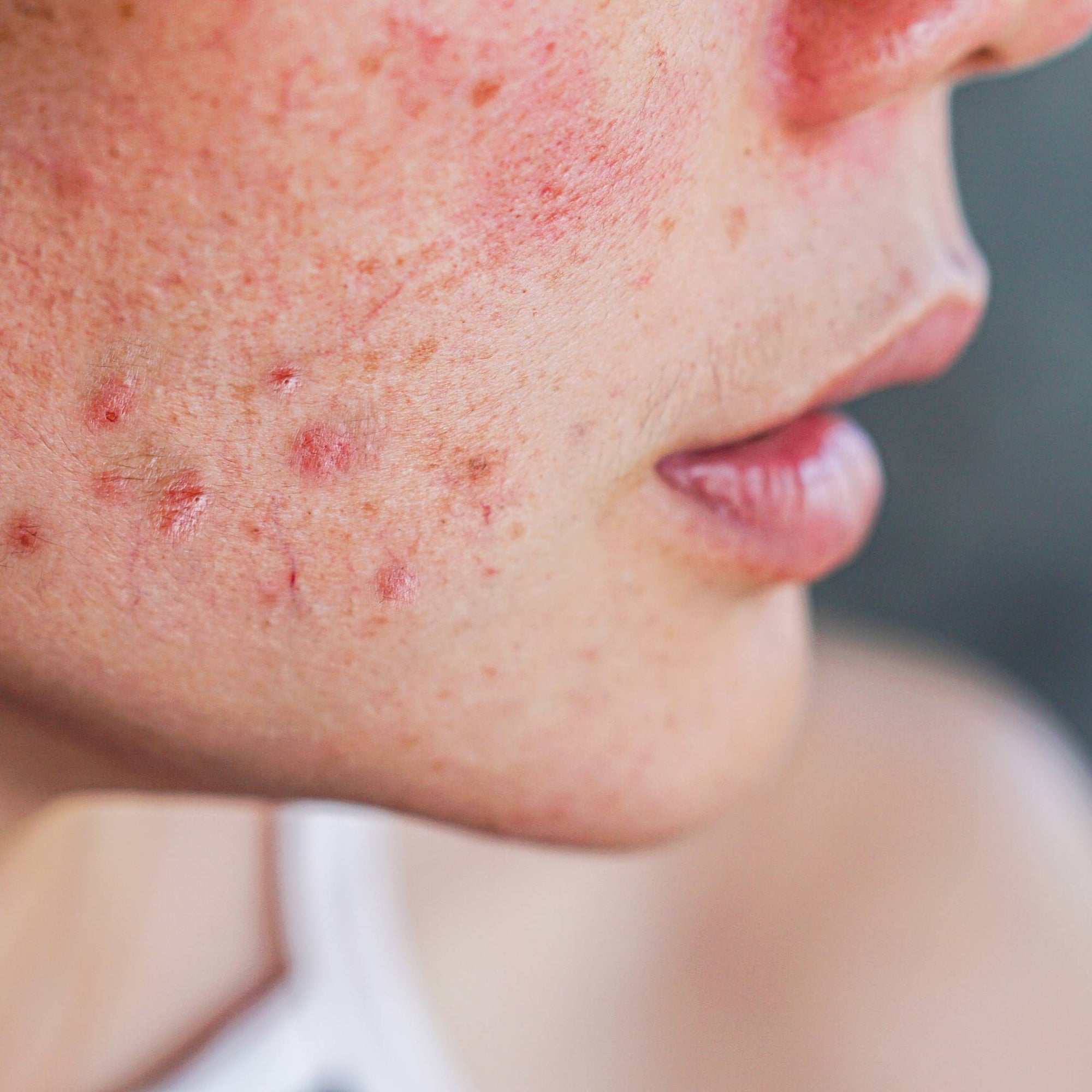 Why Do I Get Acne?