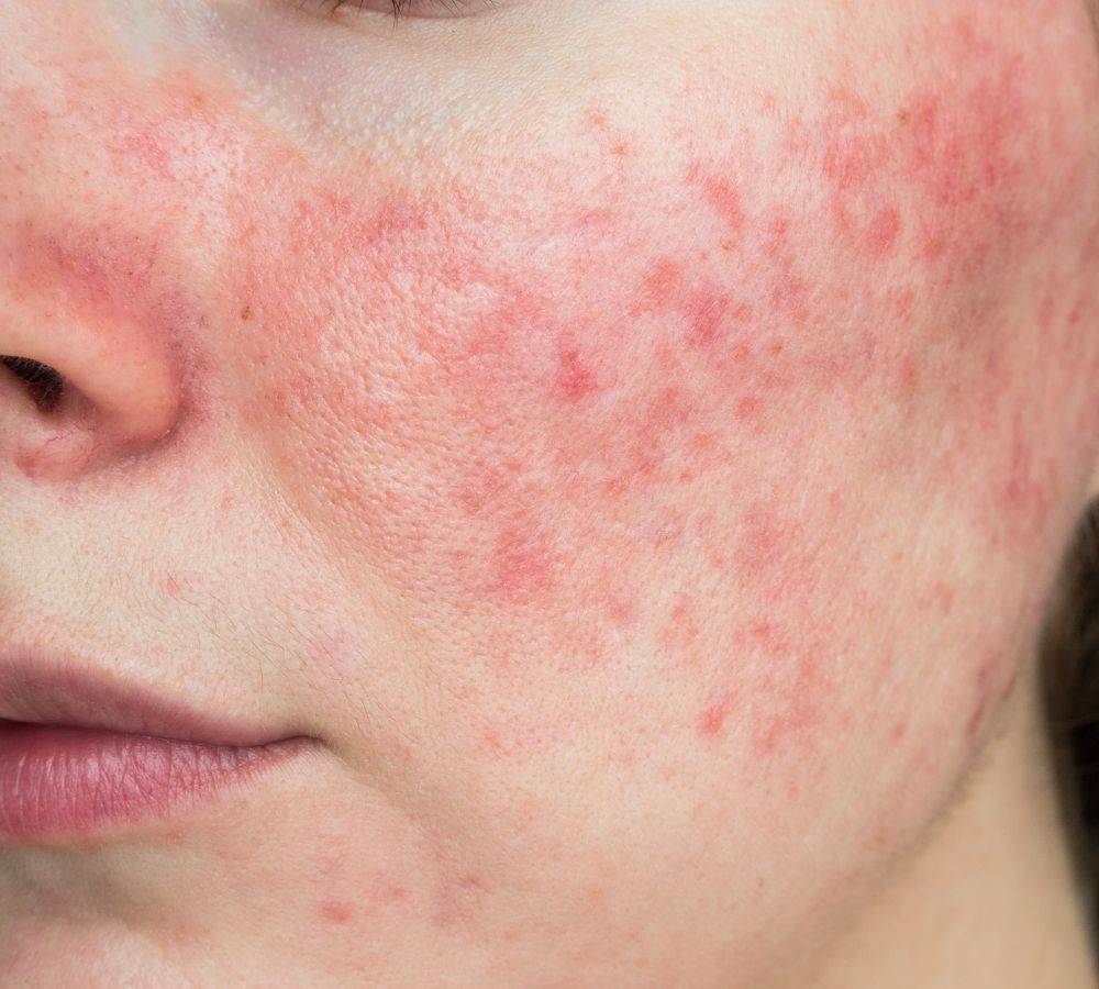 Is my Skin Sensitive or Sensitised?