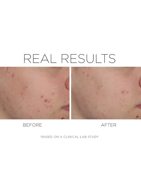 CosMedix Shineless Before/After